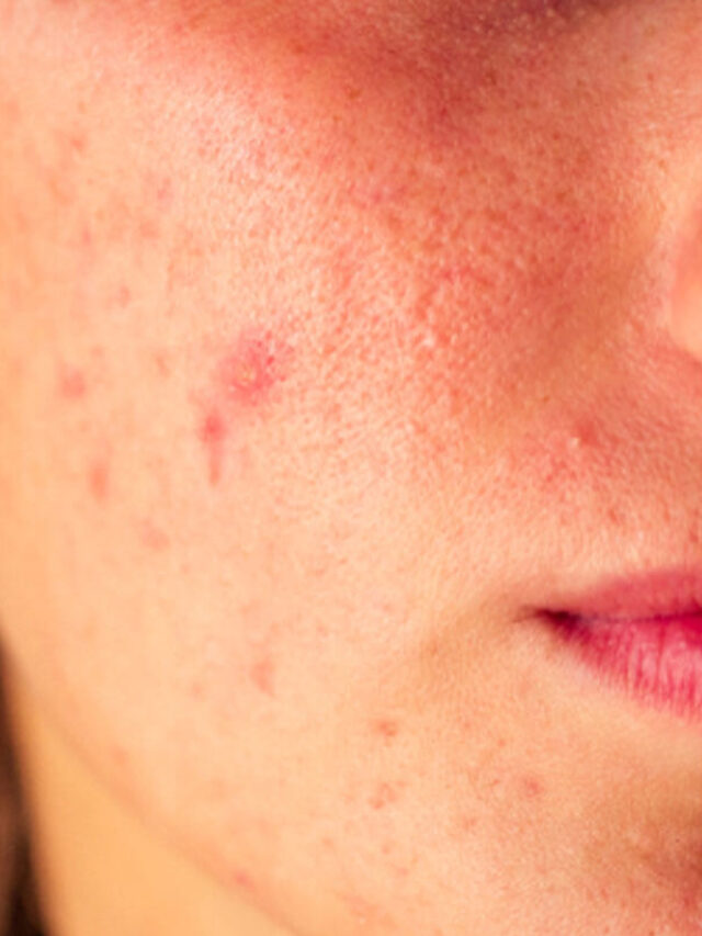 Home remedies for acne