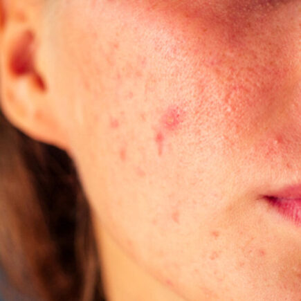 Home remedies for acne
