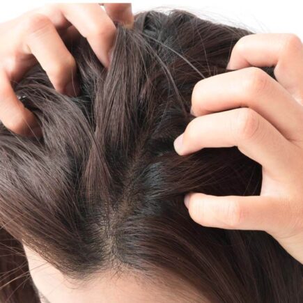 4 Natural Home Remedies to Get Rid of Dandruff at Home
