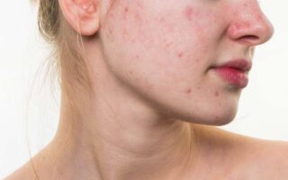 Top 5 Skin Brightening Cream In India