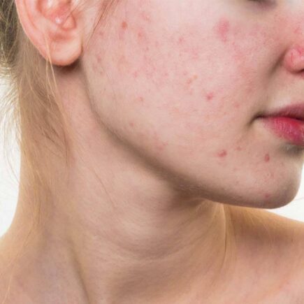 Top 5 Skin Brightening Cream In India