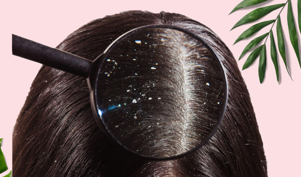 Best Anti Dandruff Shampoo Suggested by Dermatologist in India