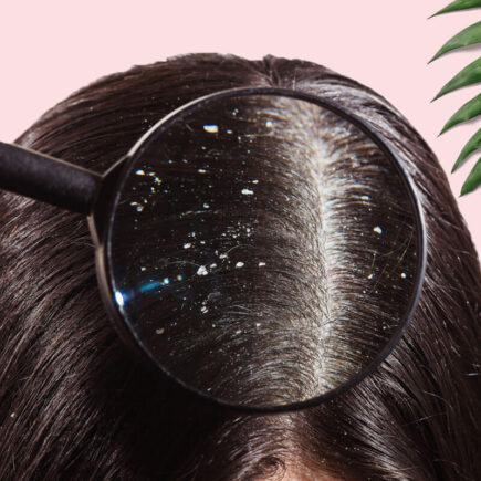 Best Anti Dandruff Shampoo Suggested by Dermatologist in India