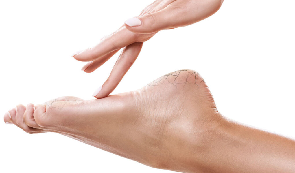 How to Get Rid of Cracked Heels or Feet During Winter - Home Remedies for Cracked Feet