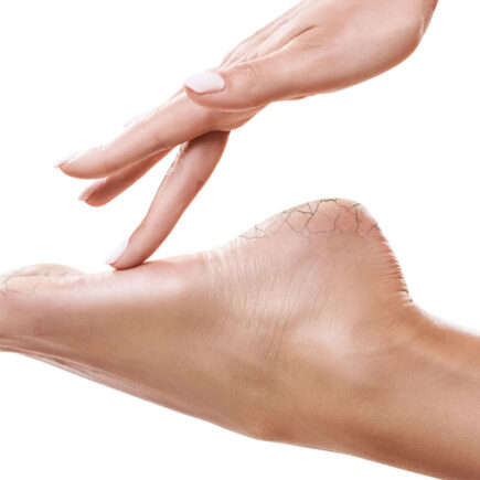 How to Get Rid of Cracked Heels or Feet During Winter - Home Remedies for Cracked Feet
