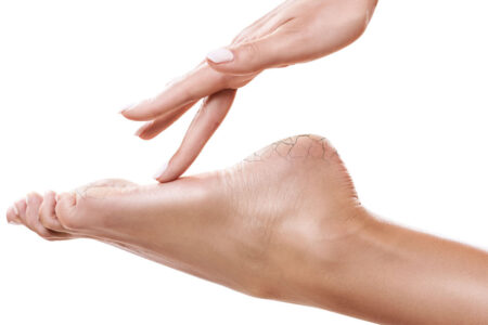 How to Get Rid of Cracked Heels or Feet During Winter - Home Remedies for Cracked Feet