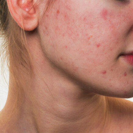 Top-5-Reasons-for-Pigmentation-on-Face-and-How-to-Remove-It-