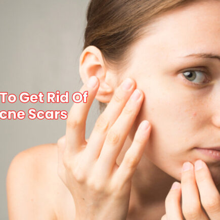 Top-5-Ways-to-Get-Rid-of-Acne-Scars-at-Home-How-To-Get-Rid-Of-Acne-Scars-1