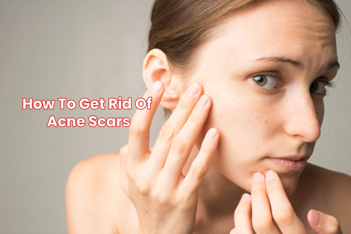 Top-5-Ways-to-Get-Rid-of-Acne-Scars-at-Home-How-To-Get-Rid-Of-Acne-Scars-1