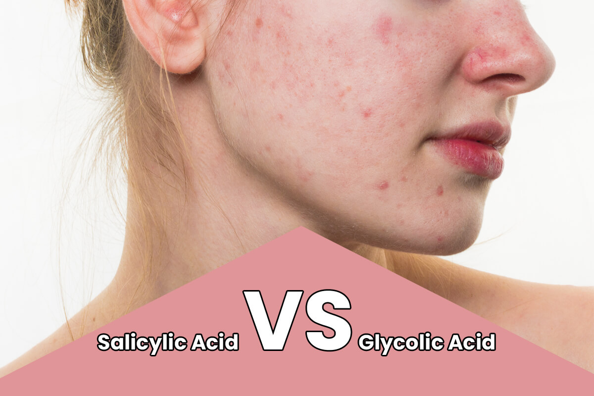 Salicylic-Acid-VS-Glycolic-Acid-Which-Is-Good-For-Acne-1.jpg File type: image